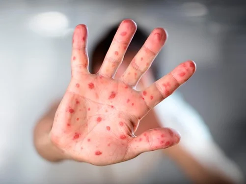إصابة الأطفال بالحمى القلاعية